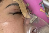 Cô gái 27 tuổi bị mù 1 mắt sau khi tiêm filler nâng mũi tại spa