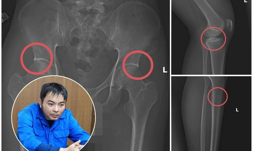 Nóng: Cựu cán bộ y tế cầm đầu đường dây tự đục vỡ xương khớp để lấy bảo hiểm