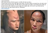 H'Hen Niê tiết lộ bị nổi mề đay sau sinh, bác sĩ nói gì về tình trạng này?
