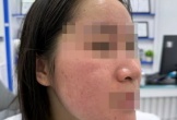 Lãnh hậu quả sau 1 tuần trị mụn bằng nước cốt chanh