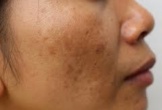 Những dấu hiệu cho thấy làn da đang mất dần collagen mà không phải ai cũng biết
