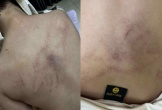 Tạm đình chỉ công tác 2 giáo viên nghi bạo hành trẻ