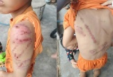 Xót xa hình ảnh cháu trai nghi bị cha đánh bầm tím khắp người