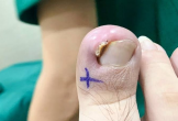 Kiện bác sĩ vì hoại tử chân khi đi cắt khóe móng
